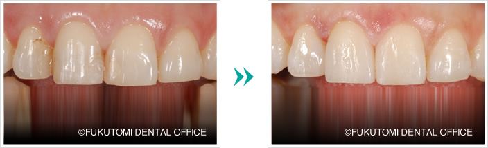 詰め物の変色をダイレクトボンディング