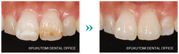 前歯の変色・白濁の症例