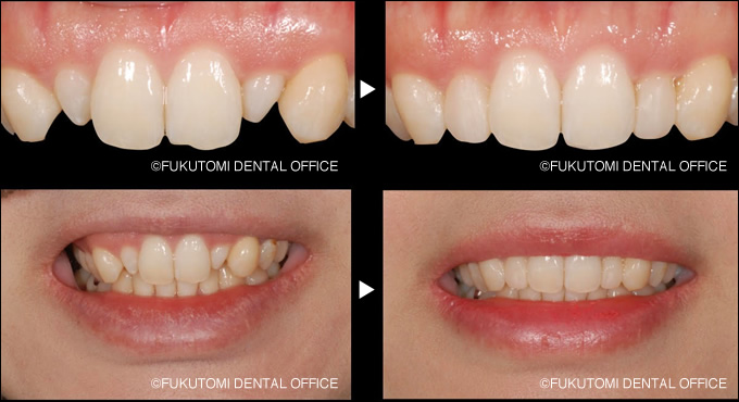 左右前歯の矮小歯の症例