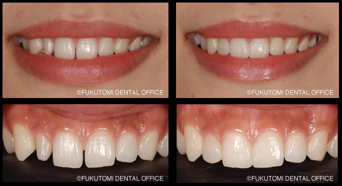 前歯のダイレクトラミネートベニアの症例
