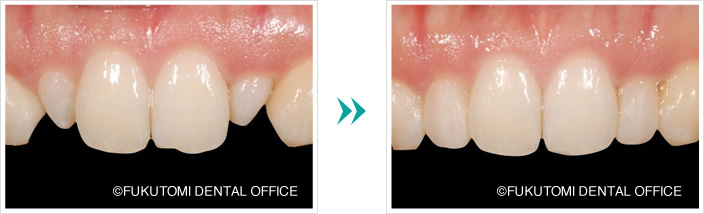 歯が小さいすきっ歯の症例