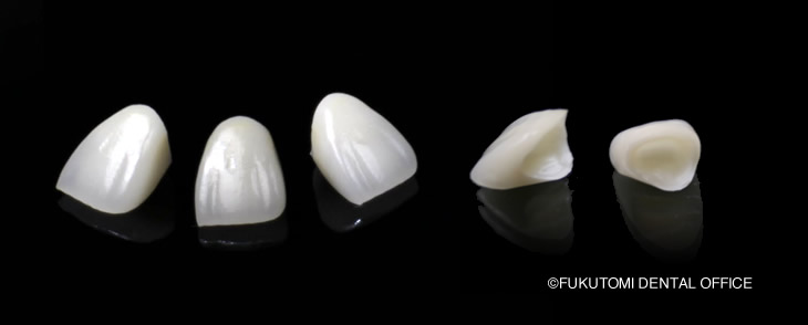 ジルコニアオールセラミッククラウン