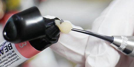 前歯のすきっ歯専門外来（歯の即日隙間治療）