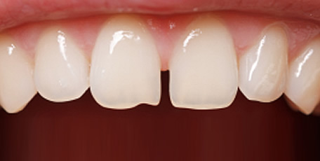 すきっ歯の症例