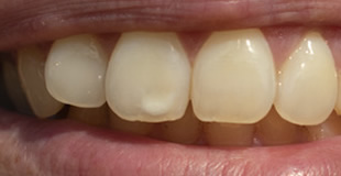 前歯の白い変色・白濁