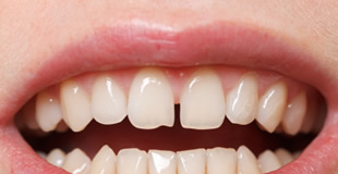前歯の隙間歯科治療